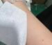 Skin-contact silicone gel application on human skin